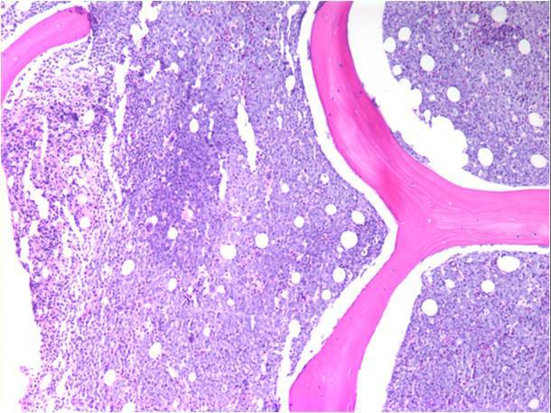 Figure 1. 2-12-10 Bone Marrow Biopsy, H&E, 100x